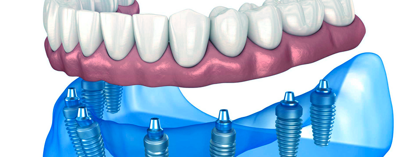 Protesi dentale fissa